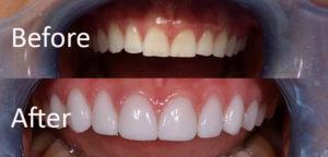 Benefit from Teeth Veneers