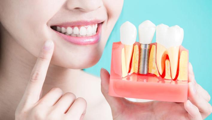 Procedure for Dental Implants