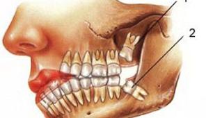 oral maxillofacial treatment in chennai