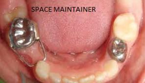 dentalimplant