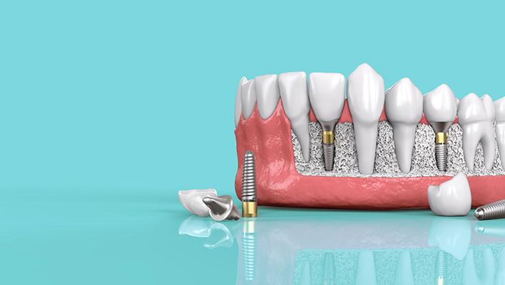 Three Reasons Dental Implants Are Worth The Cost