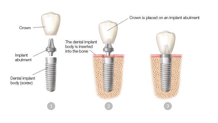 How do Dental Implants Work?