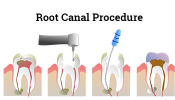 Best Root Canal Treatment in Chennai