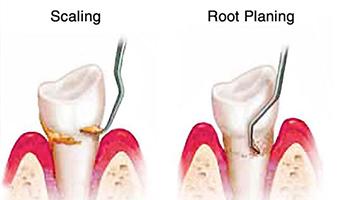 Teeth scaling Teeth Scaling