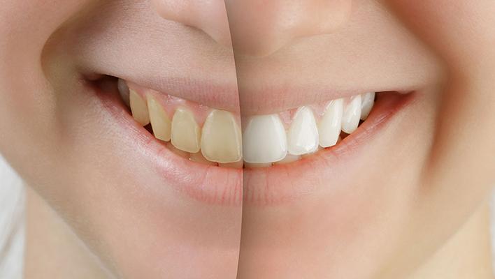Veneers are the solution for a beautiful smile