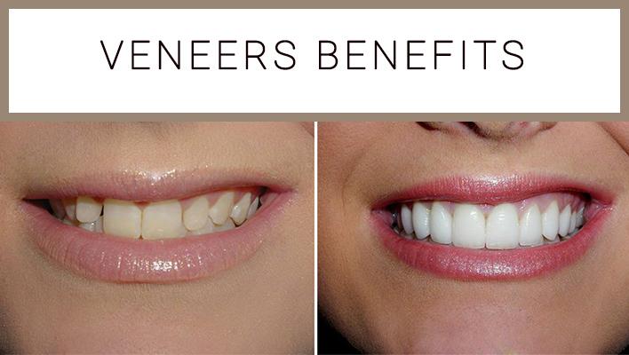 Benefit From Dental Veneers