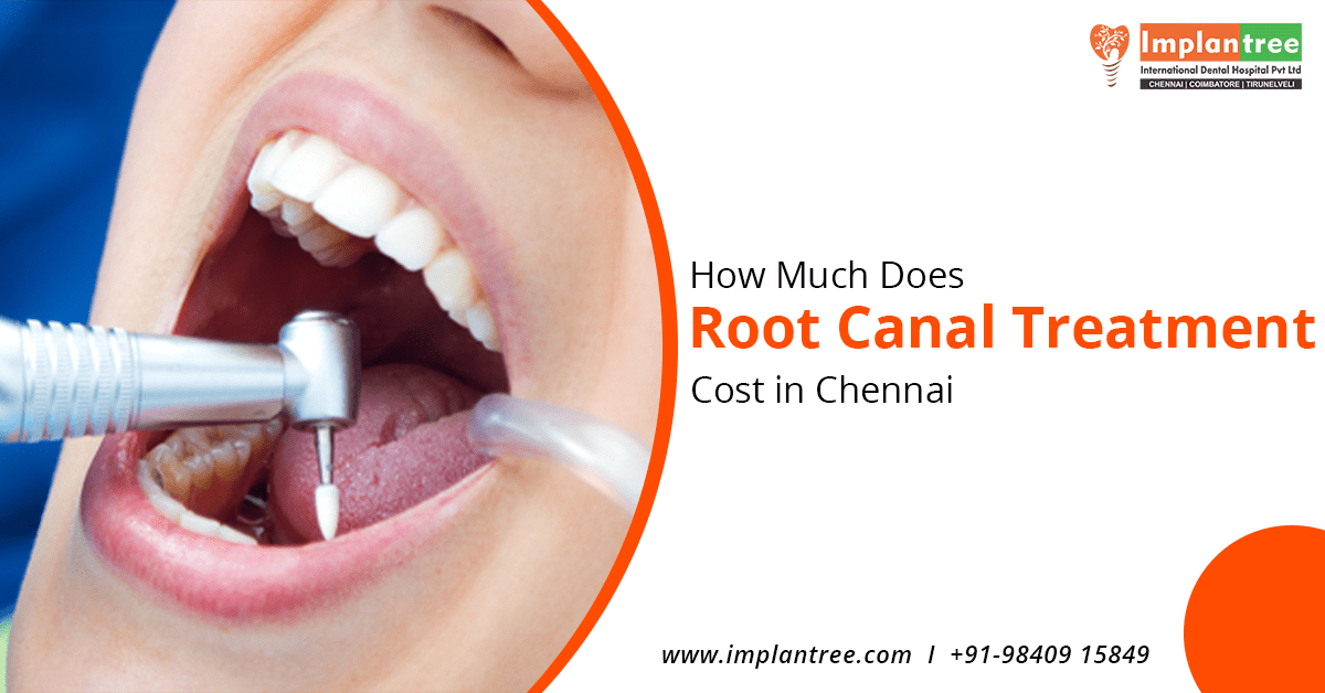 Root Canal Treatment Cost in Chennai.