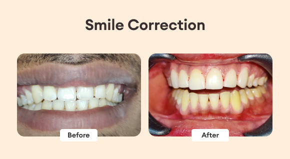 Happy Smile Before and After